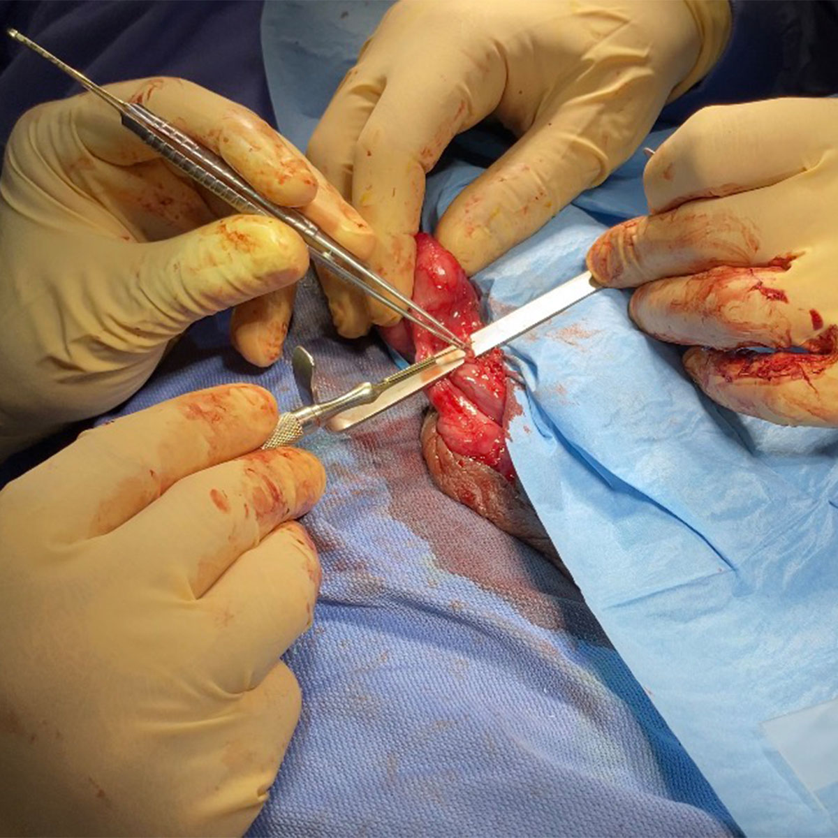Vasovasostomia