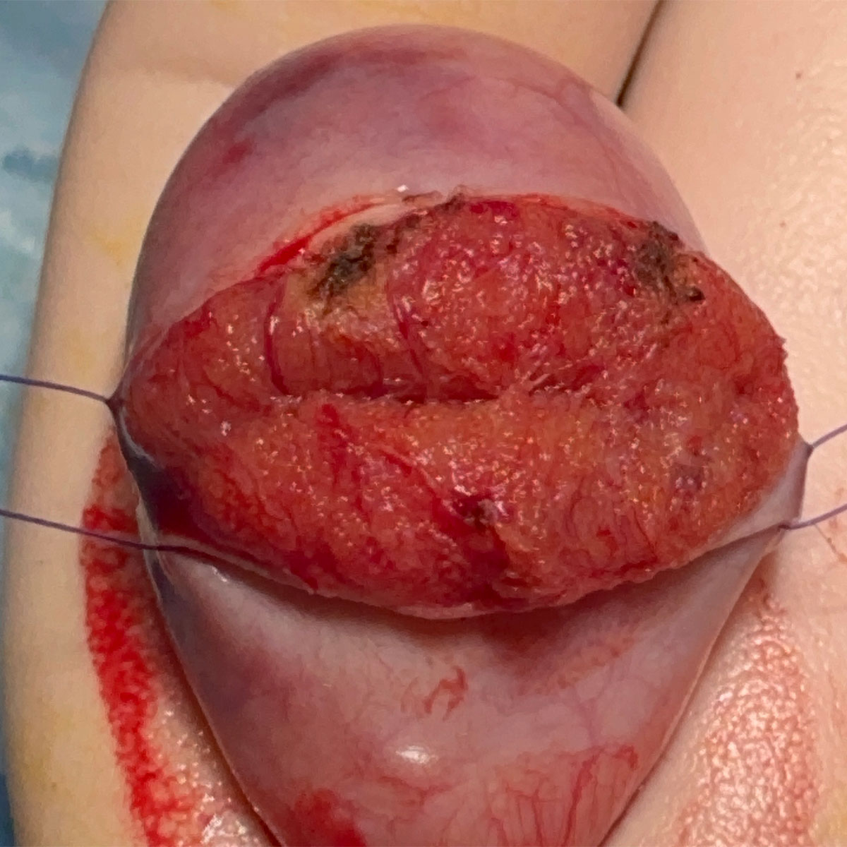 Microtese apertura testicolo